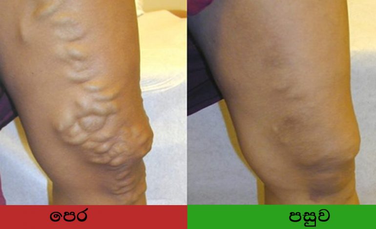 Ligation of veins